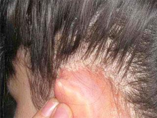Корка на голове у взрослого: причины появления сухих корочек или белой корки  на коже под волосами, перхоти и себореи, что с этим делать
